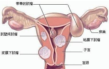 宫颈肿瘤