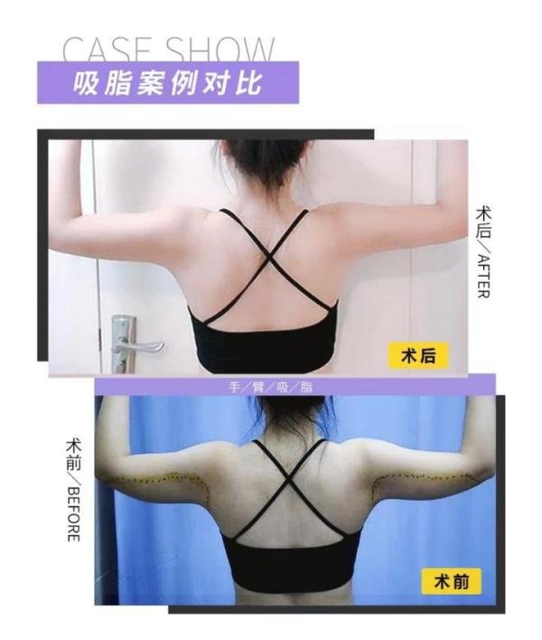 昆山手臂吸脂要注意哪些问题呢？
