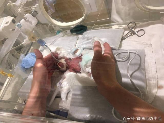 生命奇迹!“世界最小婴儿”出生仅25厘米,如今18岁的她怎样了?
