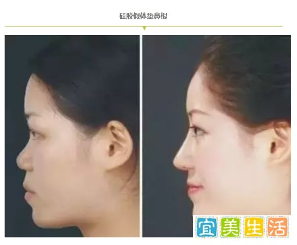 日本整容 | 那些山根低的女孩该怎么办呢?