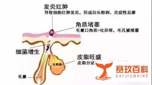 刷酸大咖|拥有20%壬二酸的美芙诺，消除油痘好稳！
