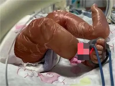 火棉胶婴儿腿症状图片