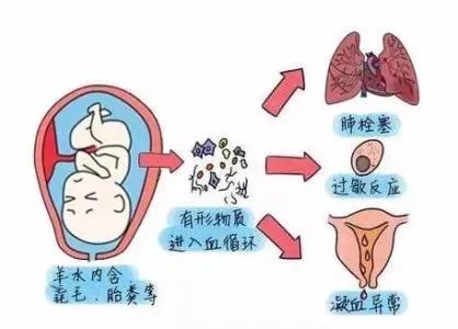 网曝刘强东妹妹因羊水栓塞去世,作为产妇“致命恶魔”的它到底有多可怕?