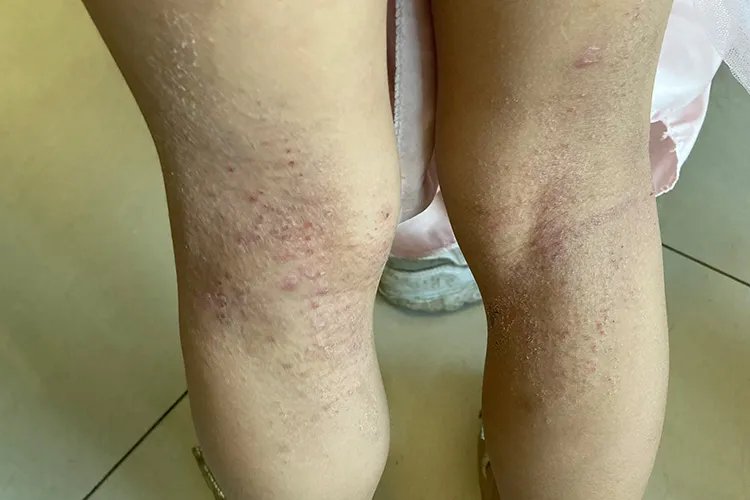 过敏性皮炎图片和症状