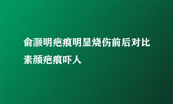 俞灏明疤痕明显烧伤前后对比素颜疤痕吓人