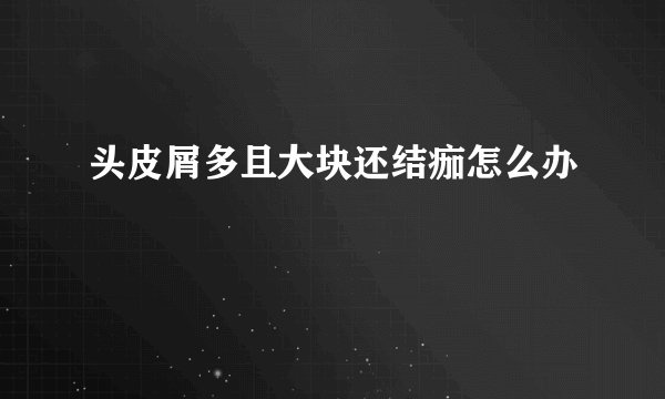 头皮屑多且大块还结痂怎么办