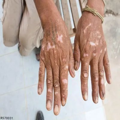 白癜风怎么治疗好点呢