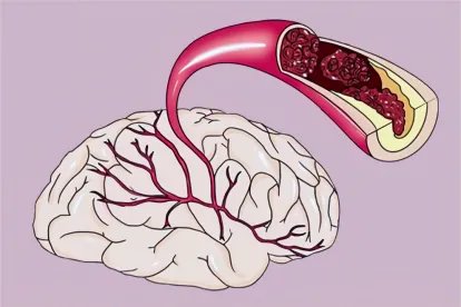 急性脑梗死图片