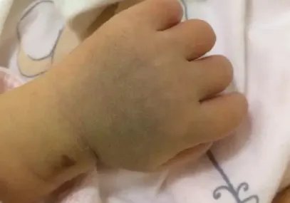 湖南双胞胎在肚子里打架出生后浑身淤青,宝宝出生时的淤青是怎样形成的?