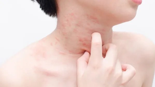 荨麻疹脱敏治疗