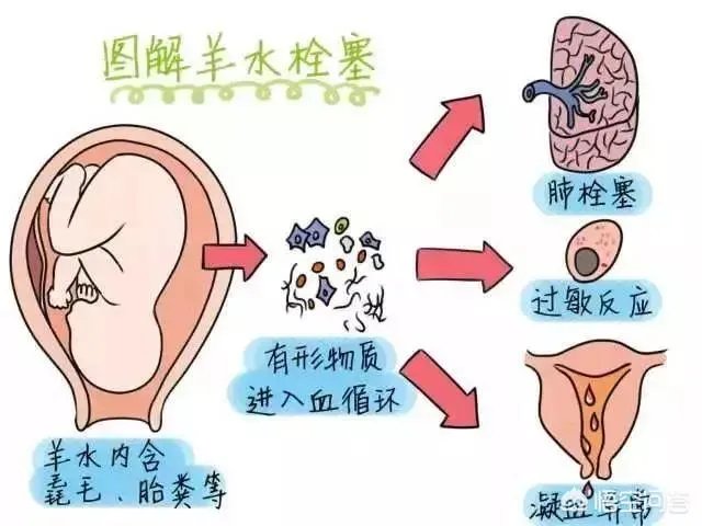 网曝刘强东妹妹因羊水栓塞去世,作为产妇“致命恶魔”的它到底有多可怕?