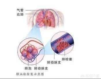 网曝刘强东妹妹因羊水栓塞去世,作为产妇“致命恶魔”的它到底有多可怕?