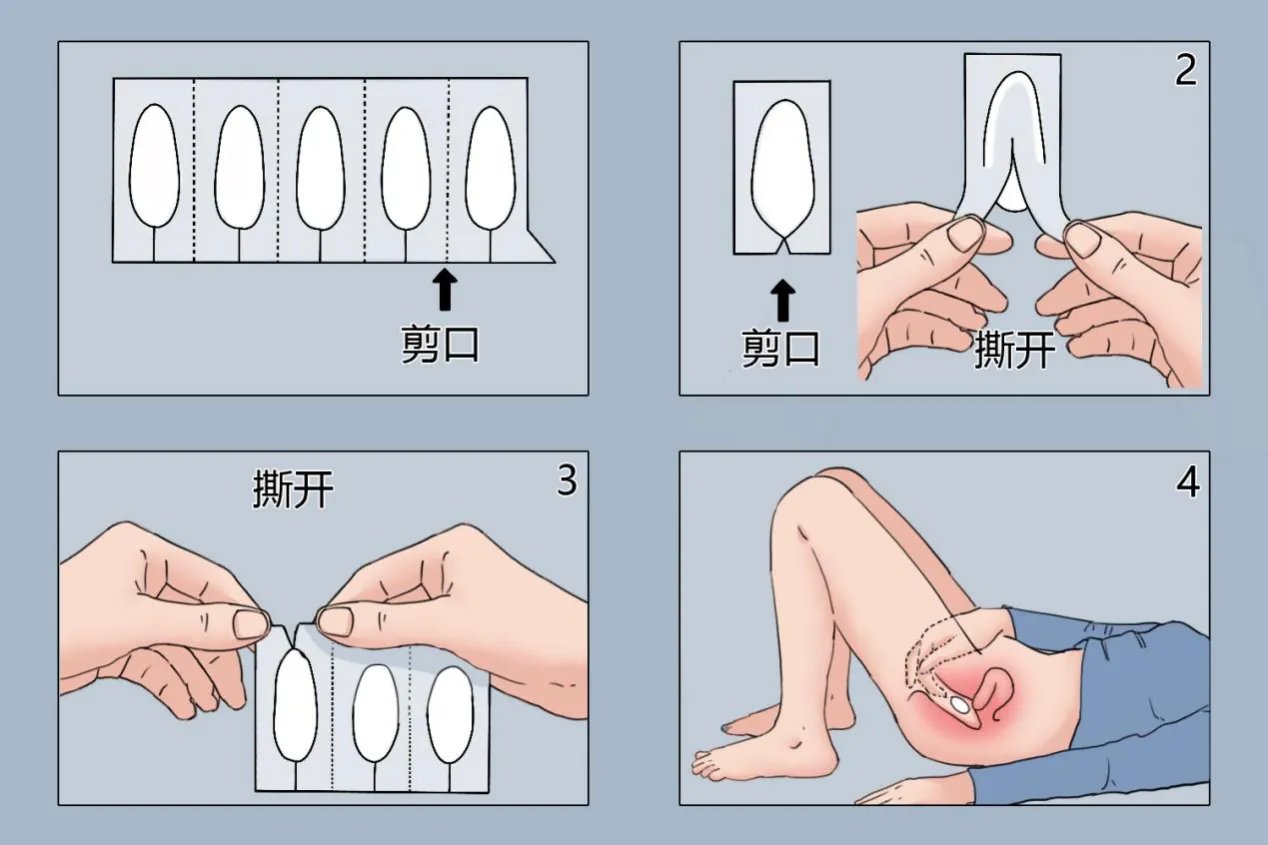 妇科栓剂使用方法图解