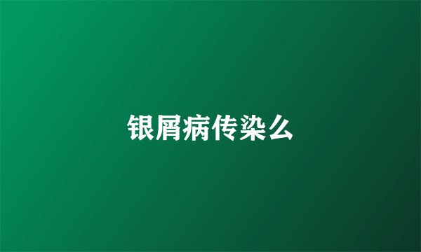 银屑病传染么