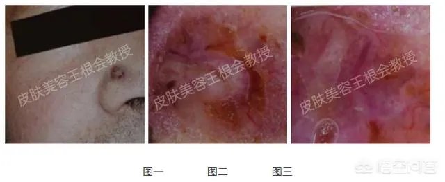 什么是基底细胞癌？
