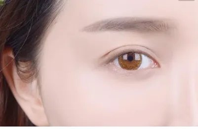 眼部埋线后要注意什么