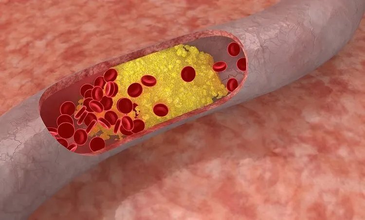 心脏支架降价后，医生开始滥用药物球囊？球囊会替代支架吗？